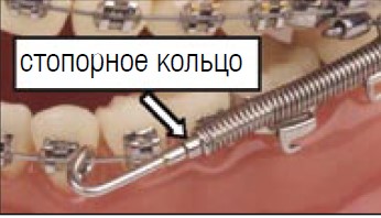 Установка Forsus™ EZ_7